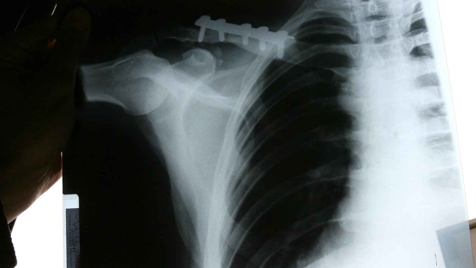 Curtain broken collar bone x-ray, Valencia WSS 2007