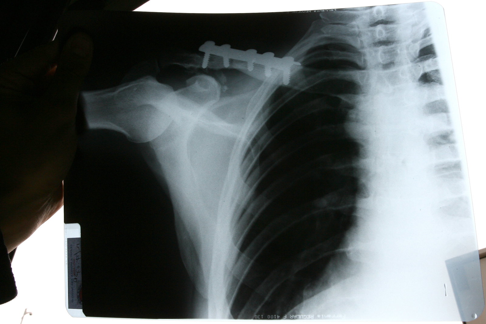 Curtain broken collar bone x-ray, Valencia WSS 2007